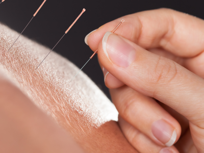 How Acupuncture Can Relieve GERD Symptoms